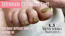 👣How To Pedicure Extremely Calloused Feet - The Most Difficult ...