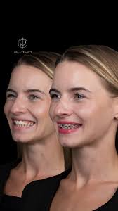 Nowy uśmiech w jeden dzień