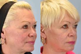 Laser Resurfacing Gallery