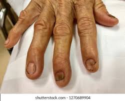 Image result for Koilonychia feet