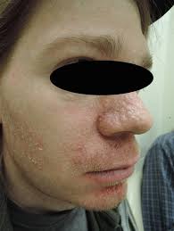 Hypopigmentary Skin Disorders