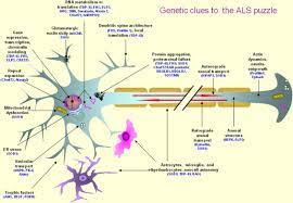 The clinical hallmarks of e are largely explained by. Amyotrophic Lateral Sclerosis An Overview Sciencedirect Topics