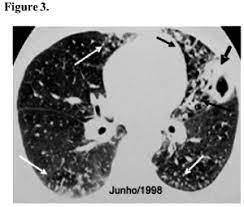 Scielo Brasil Infection With The Mycobacterium Avium Complex In Patients Without Predisposing Conditons A Case Report And Literature Review Infection With The Mycobacterium Avium Complex In Patients Without Predisposing Conditons