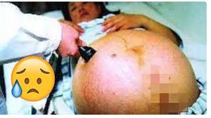 Obat aborsi cytotec 200 mcg solusi tepat untuk cara menggugurkan kandungan 1 2 3 4 5 6 7 8 bulan secara alami dan ampuh tanpa gagal. Hamil 3 Bulan Perutnya Besar Seperti Hamil 7 Bulan Saat Diperiksa Isi Di Dalamnya Ternyata Tribun Sumsel