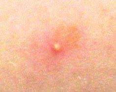Initially the bite site is mildly red and upon close what does a brown recluse bite look like in the early stages? Brown Recluse Spider Bites