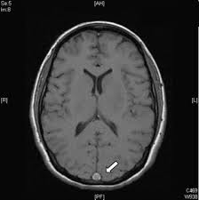 Existen factores de riesgo externos y genéticos que predisponen a esta enfermedad lo que hace necesario un estudio profundo para pautar el tratamiento. Trombosis Venosa Cerebral Aspectos Actuales Del Diagnostico Y Tratamiento Sciencedirect