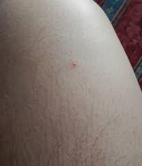 People hear the word herpes and automatically freak out. Pimples On Body Dermatology Forums Patient