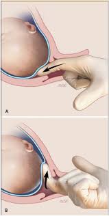 Image result for Labor Induction