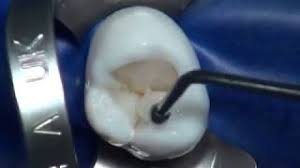Processing the return can take another month or two. How Long Does A Filling Take Dental Guide Australia