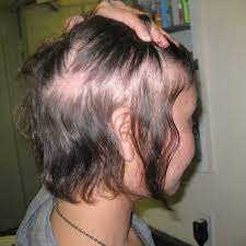 Akhirnya ada 3 cara mudah mengatasi rambut keriting kusut yang susah diatur, hanya gunakan. Penyebab Rambut Lebih Rontok Di Awal Kehamilan Tara Nature