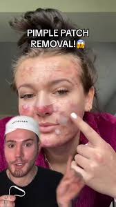 CRAZY PIMPLE PATCH REMOVAL!😱 (follow for more!💗) #acnetreatment #acneskin  #acnefighter #skincaretips #skincare101 #skincareroutine #skincareproducts  #acneskincare