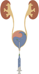 Image result for Bladder Irrigation