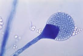 Black fungal infection causes black fungus is present almost everywhere in our common life. Black Fungus Infection Adds To India S Covid 19 Burden Goats And Soda Npr