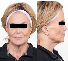 Marked Hypoleptinemia Precedes Overt Fat Loss in Immune Checkpoint  Inhibitor-induced Acquired Generalized Lipodystrophy