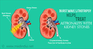 Kidney Stones Zapping Technology By Nasa To Help Treat Astronauts With Stones