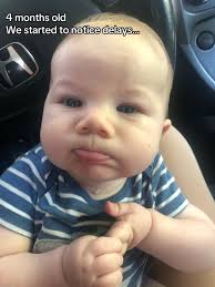 Delayed Motor Skills at 9 Months