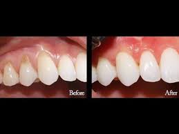 Receding gum product line treatment naturally. How To Reverse Receding Gum Line At Home Gum Treatment Receding Gums Receeding Gums