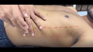 Image result for Shifting Dullness Test