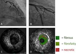 How To Prevent And Manage Radiation Induced Coronary Artery Disease Heart
