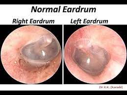 The Normal Eardrum Otoendoscopy View Ear Anatomy Middle Ear Ear Diseases