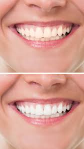 What is the difference between . Cosmetic Dentist In Ogden Jim Ellis Dds 801 394 4519 Best Ogden Dentist