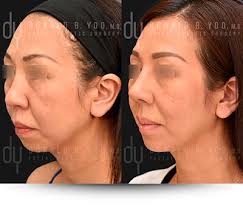 Beverly Hills Facial Plastic Surgery