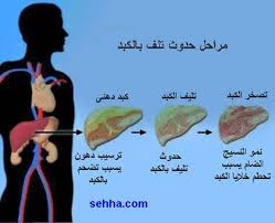 .i noticed the other day that i had some blue spider like veins on hi those could be spider naevi. Ø§Ù„ÙƒØ¨Ø¯ Ø§Ù„Ø¯Ù‡Ù†ÙŠ Ø§Ù„Ù…ÙˆØ³ÙˆØ¹Ø© Ø§Ù„Ø·Ø¨ÙŠÙ‡