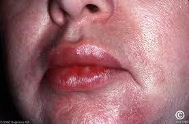 Image result for Angioedema