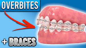 Overbites can cause all sorts of oral health issues if left untreated. How Do Braces Fix Overbites Premier Orthodontics