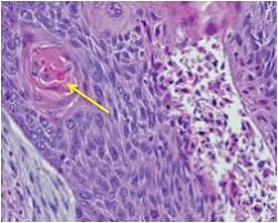 Other risk factors for mesothelioma include exposure to thorotrast and repeated mesothelial irritation. Lung Cancer Oncology Medbullets Step 1