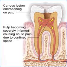 Image result for Pulpitis