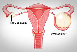 Medical illustration comparing a normal ovary with an ovary containing a cyst