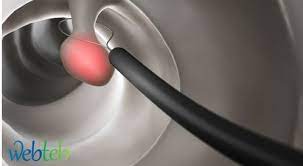 Indicators of a high quality screening colonoscopy program. ØªÙ†Ø¸ÙŠØ± Ø§Ù„Ù‚ÙˆÙ„ÙˆÙ† Ø·Ø±ÙŠÙ‚Ø© Ø§Ø¬Ø±Ø§Ø¡ Ø§Ù„ÙØ­Øµ ÙˆØªØ­Ù„ÙŠÙ„ Ø§Ù„Ù†ØªØ§Ø¦Ø¬ ÙˆÙŠØ¨ Ø·Ø¨
