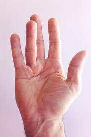 About Dupuytren's Contracture - Florida Hand Center