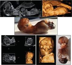 What is meant by dating in tamil. The Antenatal Detection Of Fetal Limb Anomalies Intechopen