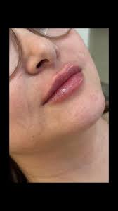 ✨Sabia que 1ml já pode deixar seus lábios mais definidos e bonitos, sem  perder a naturalidade?, É o toque certo, na medida certa. 💉✨