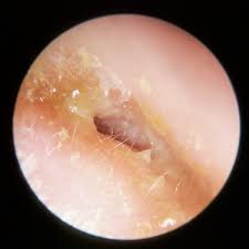 Image result for Acute Otitis Externa