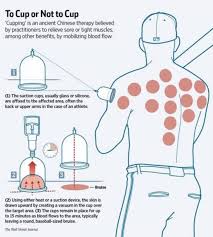 Home Cupping Therapy