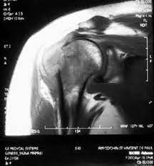 She was the wife of the late earl souders who died in 1989. Disseminated Extrapulmonary Tuberculosis Revealed By Humeral Osteomyelitis With Chronic Unremarkable Pain Sciencedirect