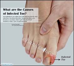 See full list on mayoclinic.org Infected Toe Causes Symptoms Treatment Diagnosis