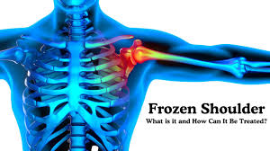 Image result for Frozen Shoulder