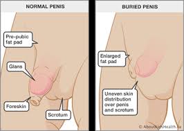 How to lose male pubic fat if you're overweight, and dieting and exercise haven't worked for you. Buried Penis In Children