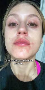 Beginning Stages of Psoriasis