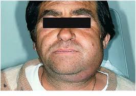 Image result for phlegmon on face)