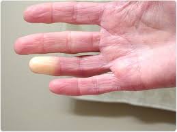 What Is Raynaud S Syndrome