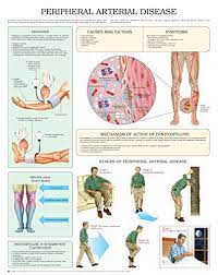 Peripheral Arterial Disease E Chart Full Illustrated English Edition Lymph Massage Peripheral Artery Disease Disease