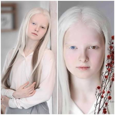 Albino girl stuns the world with her looks – just wait until you see her  sister... Photo in comments 👇🏻😍