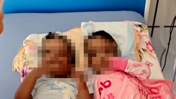Separaron con éxito a dos gemelas unidas por la cabeza: así se recuperan seis meses después de la cirugía en Estados Unidos
