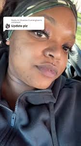 Replying to @Shanise Cunningham this is as far as it got me, ill have  another update in 2/2024 wen i go back to my dermatologist, will be doin a  bleaching for the rest of dark marks that didnt fade ...