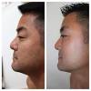 The relation between hair growth and levels of sex hormones in serum and saliva was investigated in 256 !kung san and kavango men (ages 18 to 39 years) from namibia/southern africa. 1